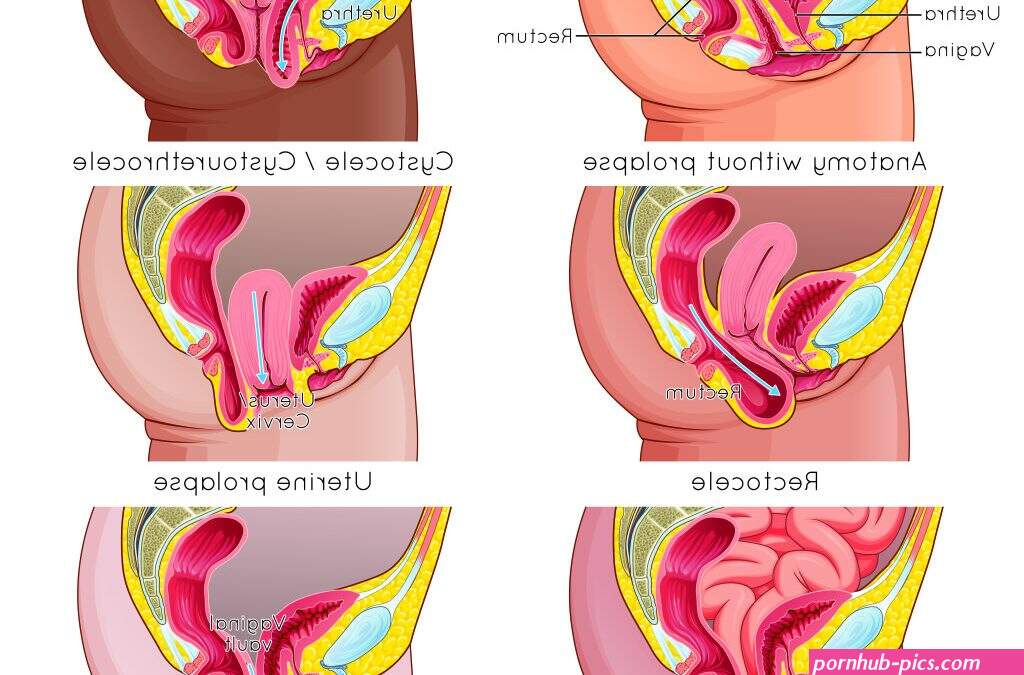 cervical prolapse creampie