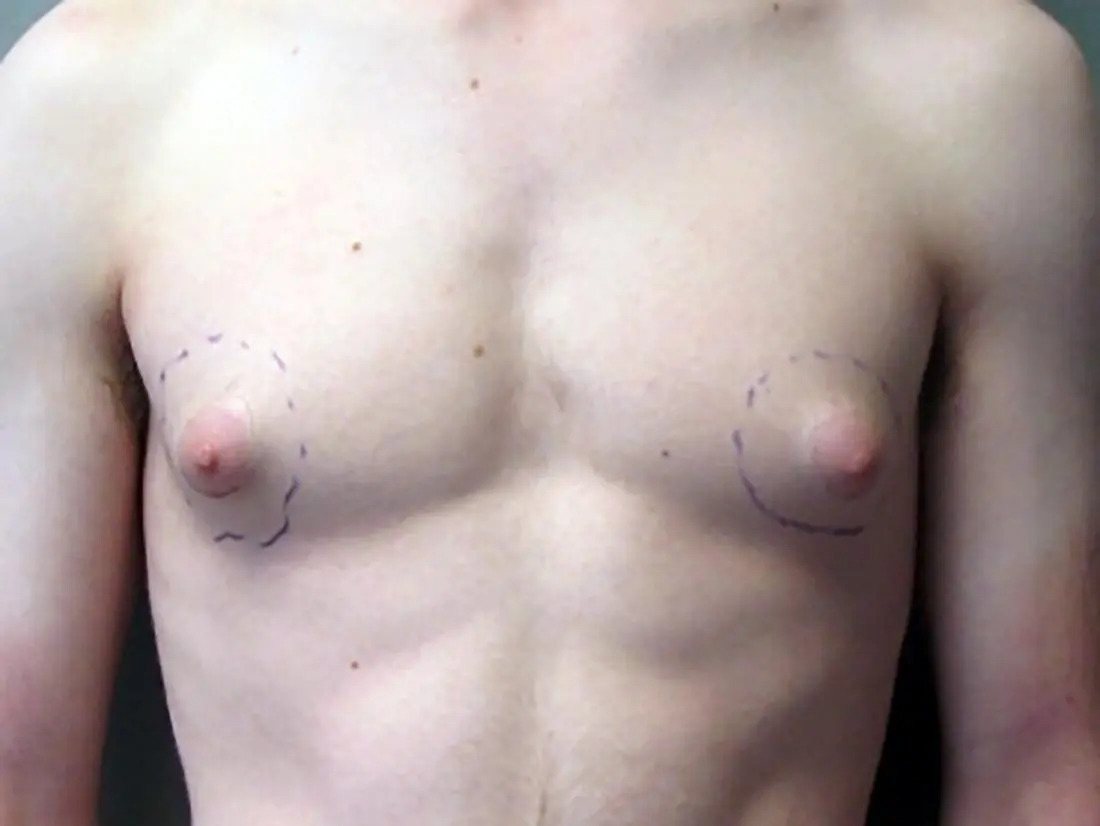 Puffy nipples in men: Remedies and causes