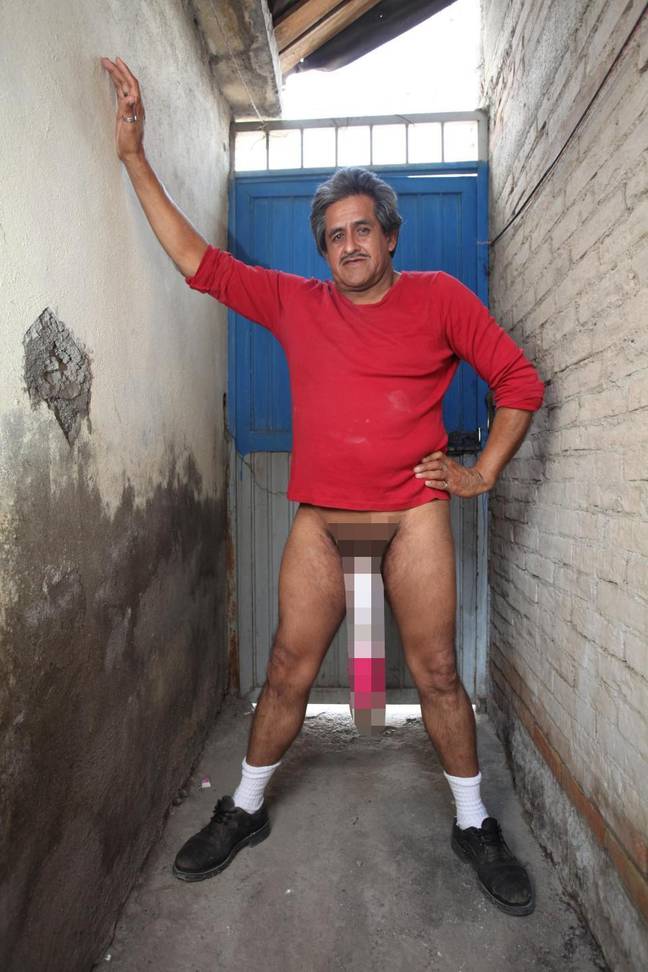 Doctor Reckons Man With Worlds Largest Penis Stretched It