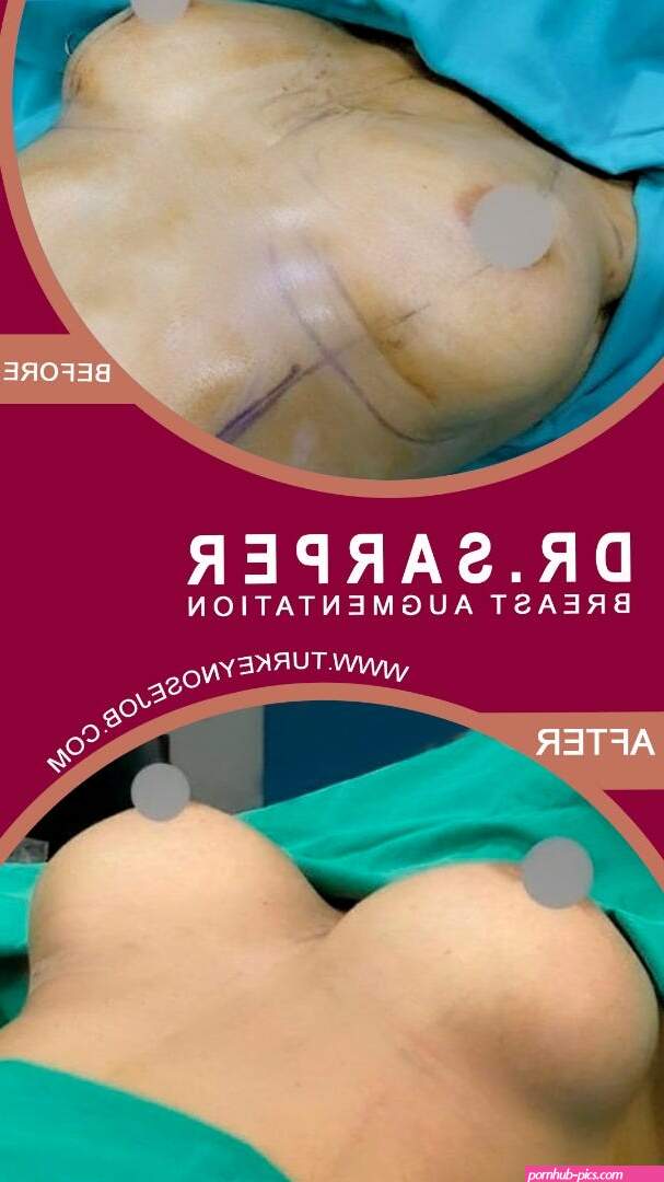 What do Beautiful Breasts Look Like?