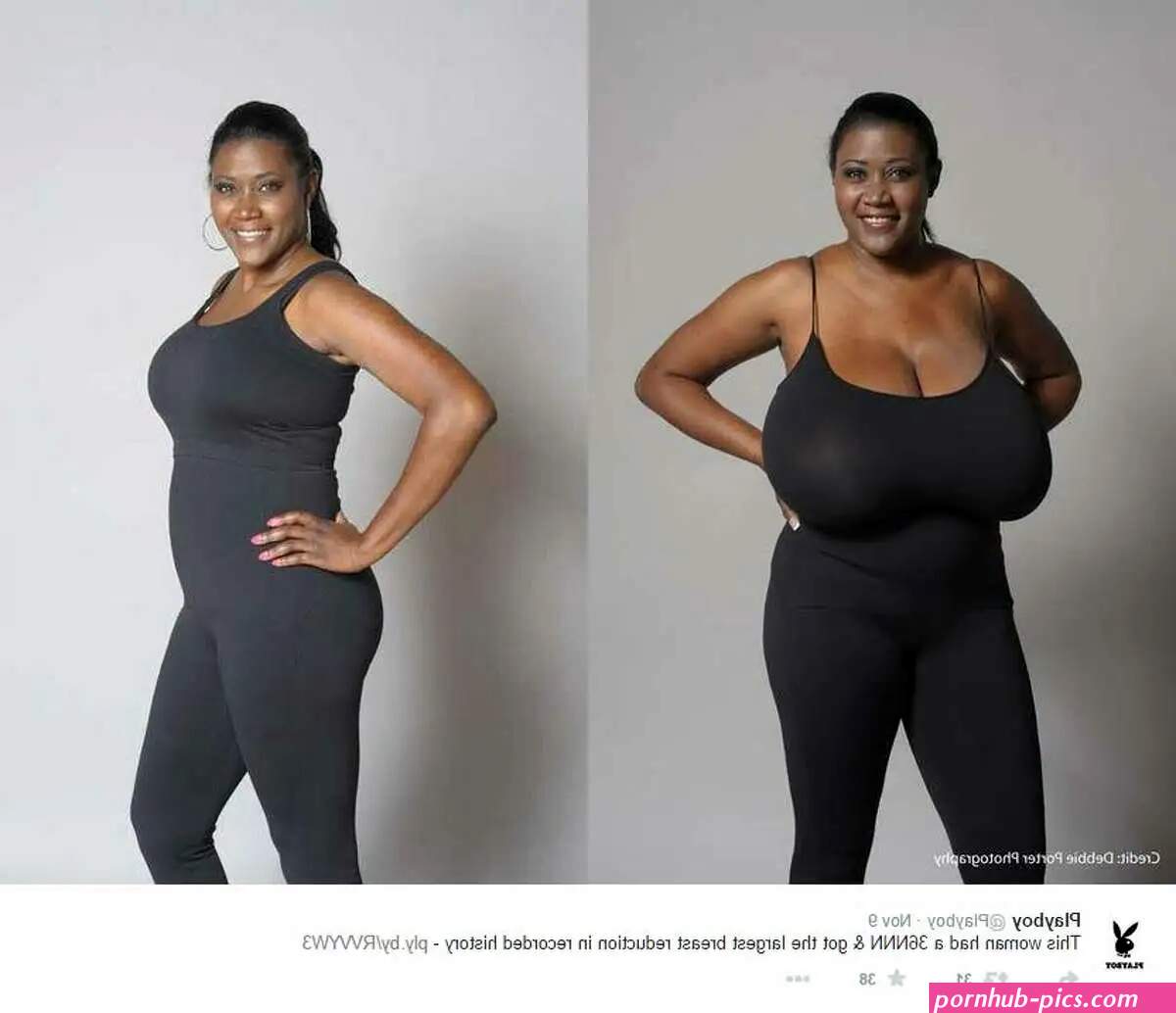 Abelena Tits Gigantomastia
