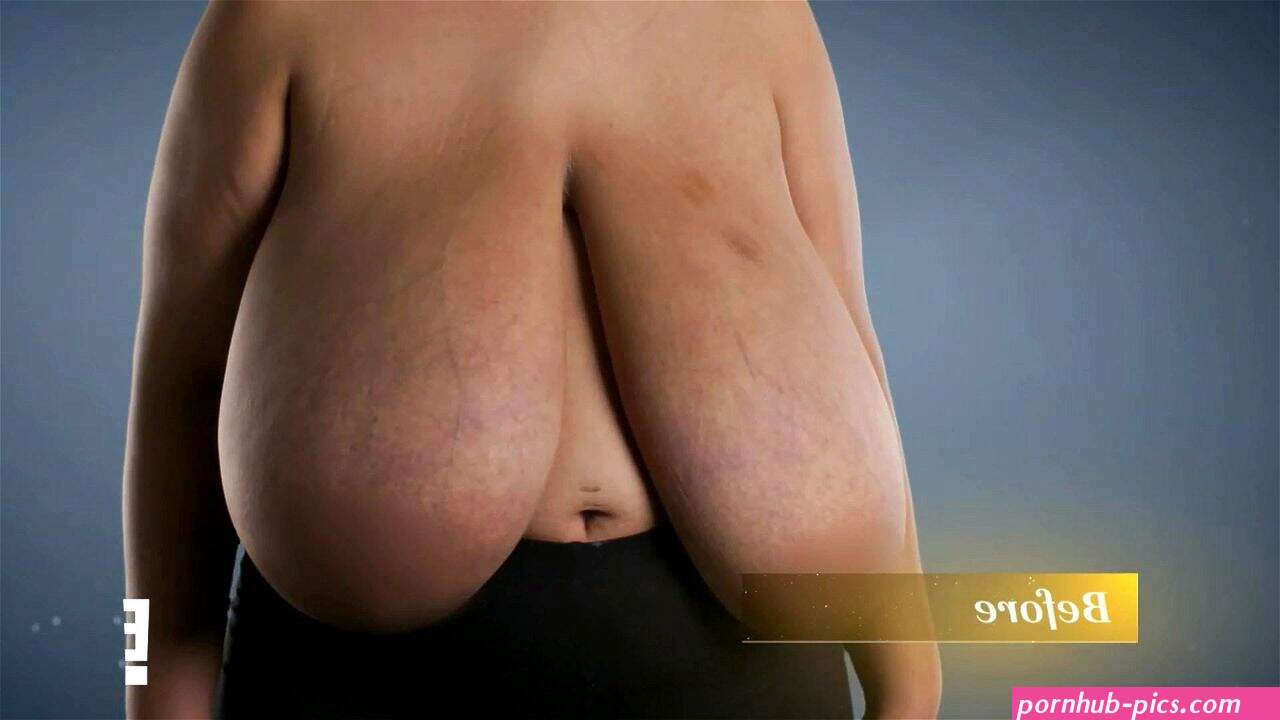 Watch Carlena reduction warning: gore surgery