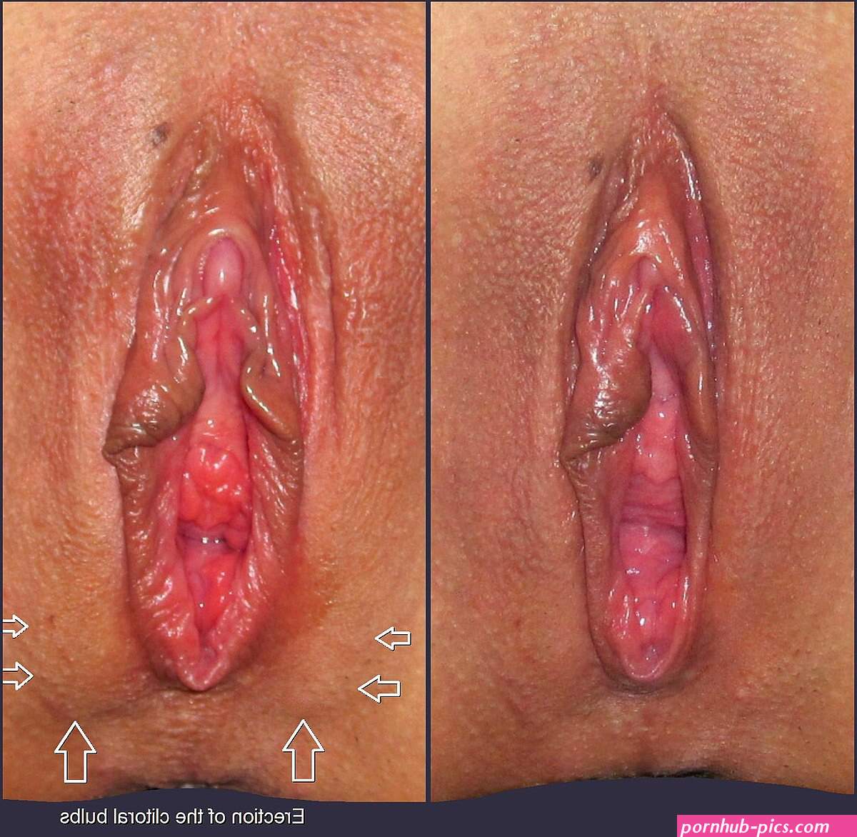 Clitoral erection