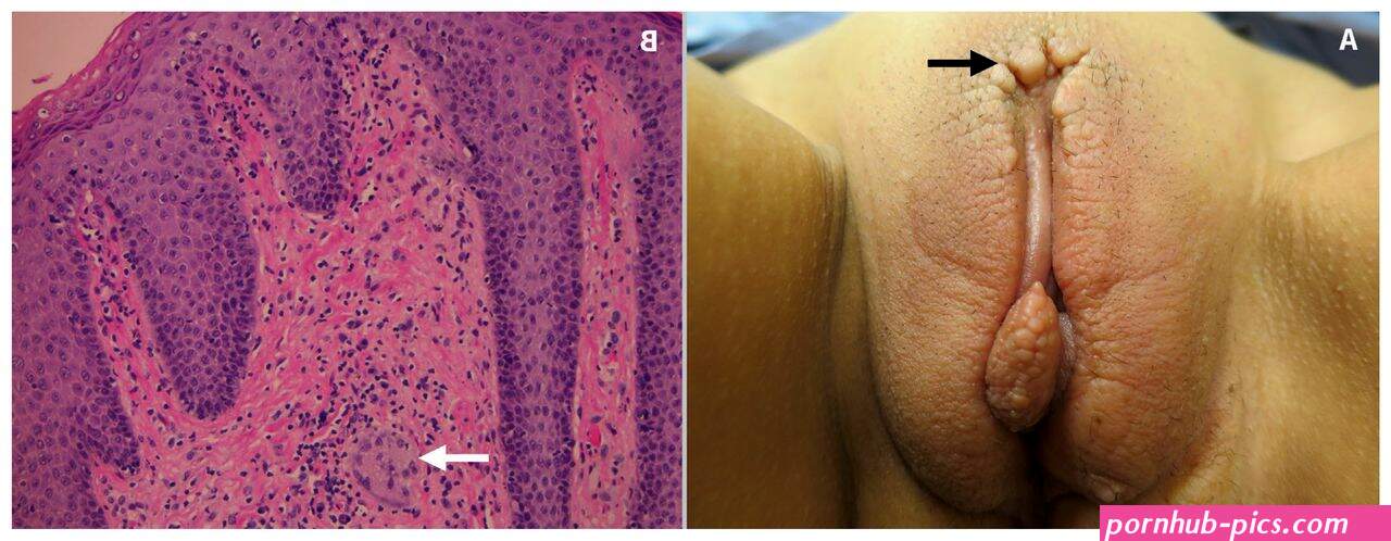 Maladie de Crohn vulvaire