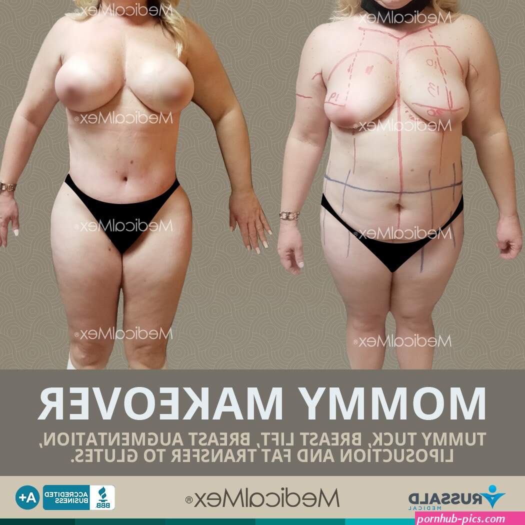 Liposuction Surgery in Tijuana Mexico Certified