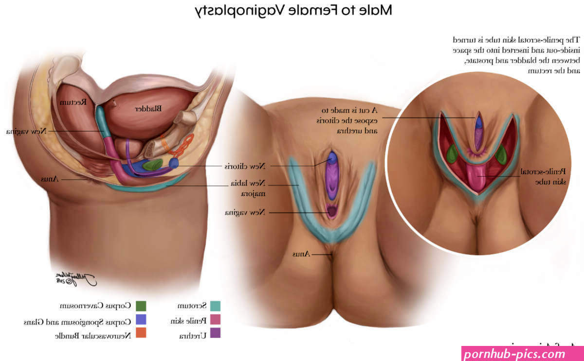Vaginoplasty for Gender Affirmation