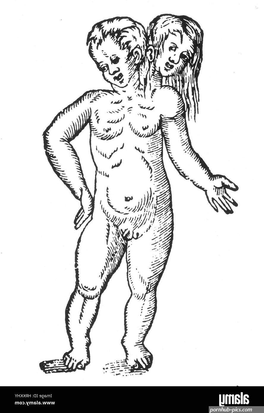 Parapagus Conjoined Twins 16th Century Stock Photo