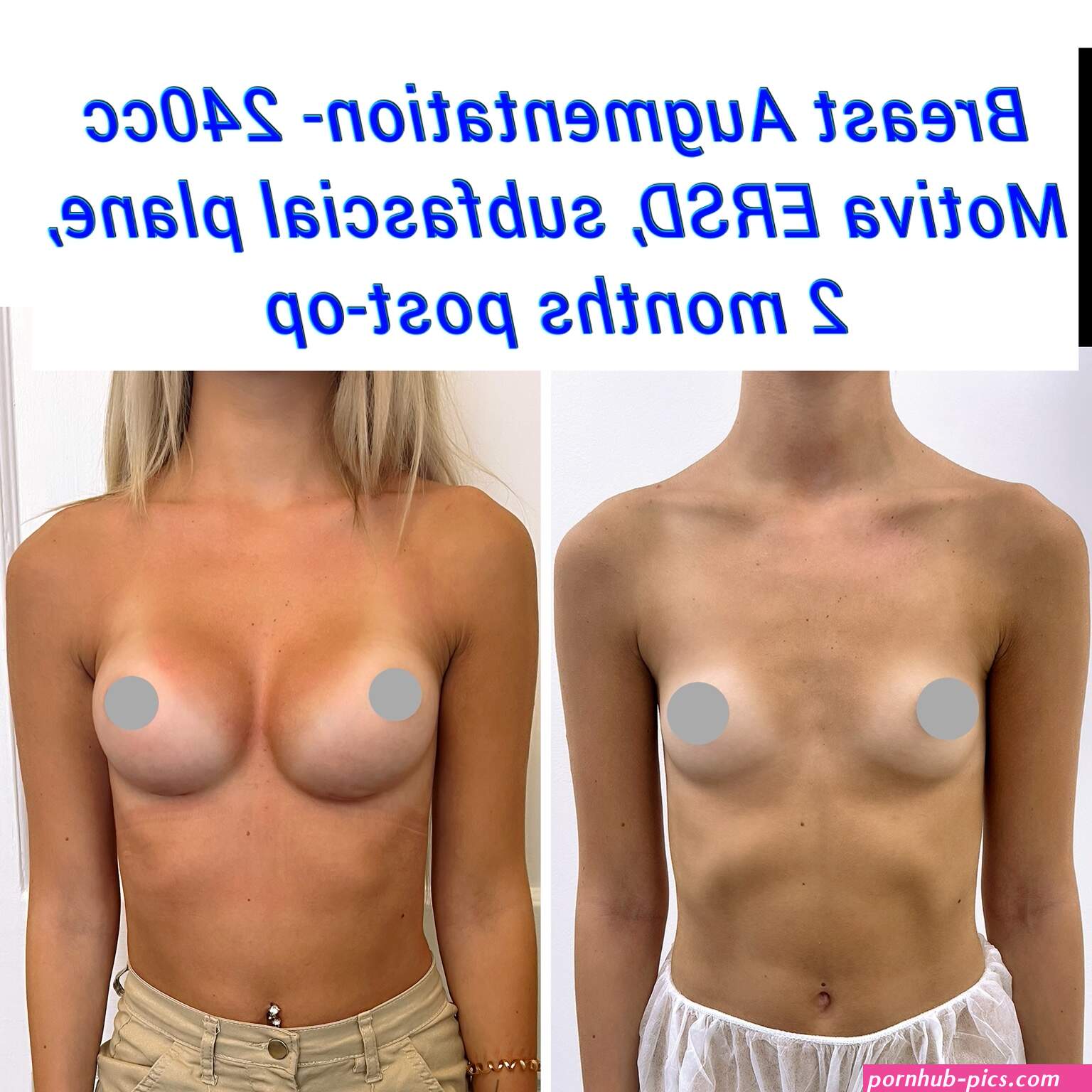 Breast Augmentation