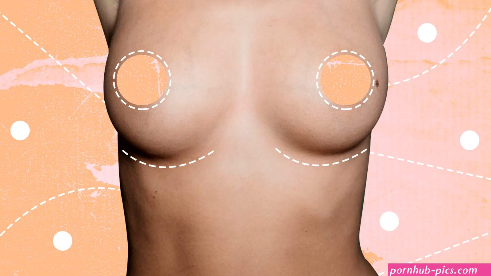 Breast Implants: Everything You Need to Know
