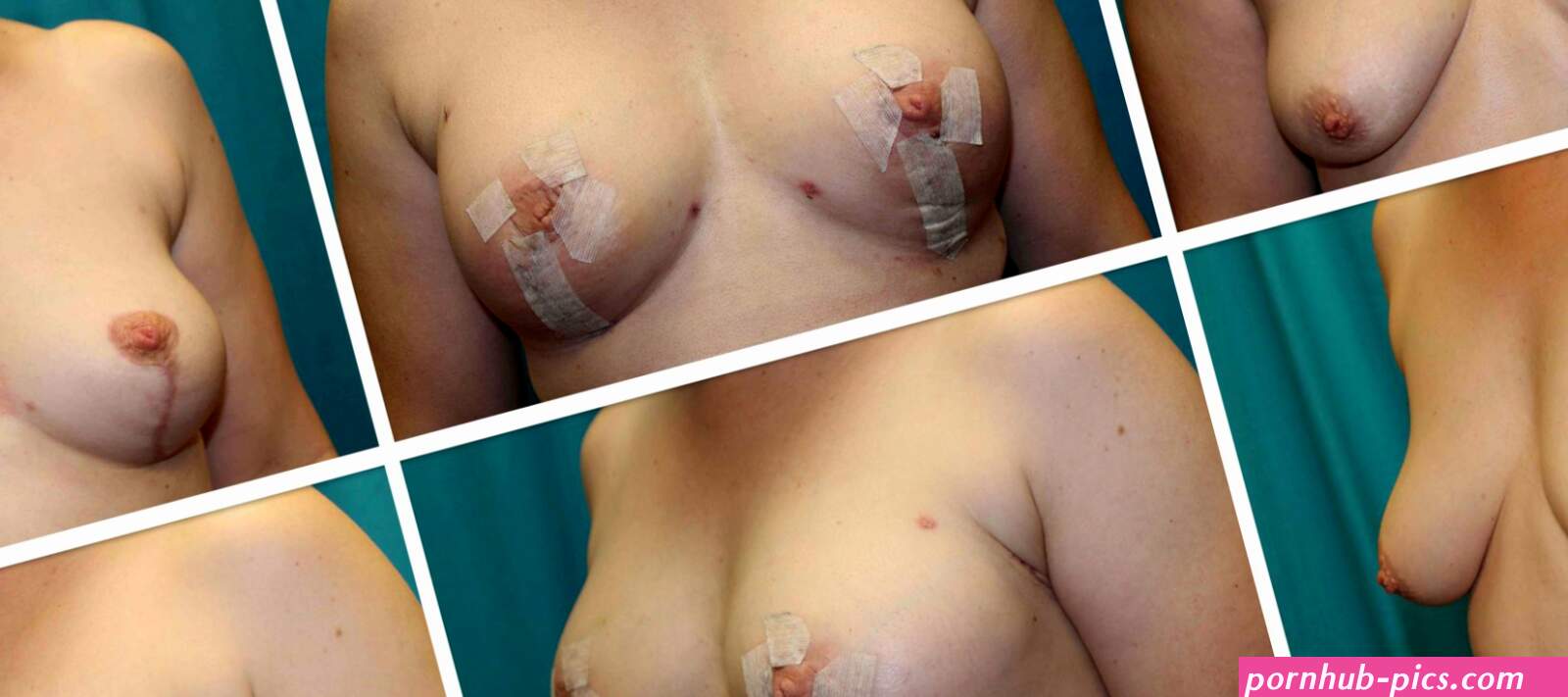 Natural breast augmentation with fat transfer in Wisconsin