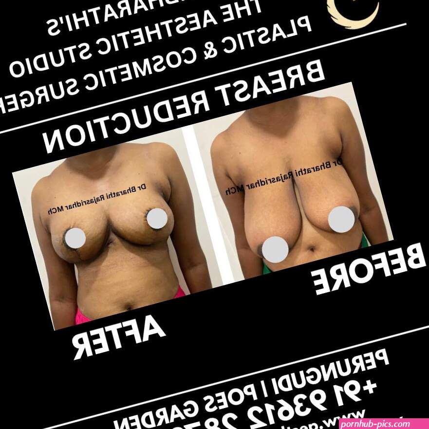 Breast Reduction surgery is done to address large