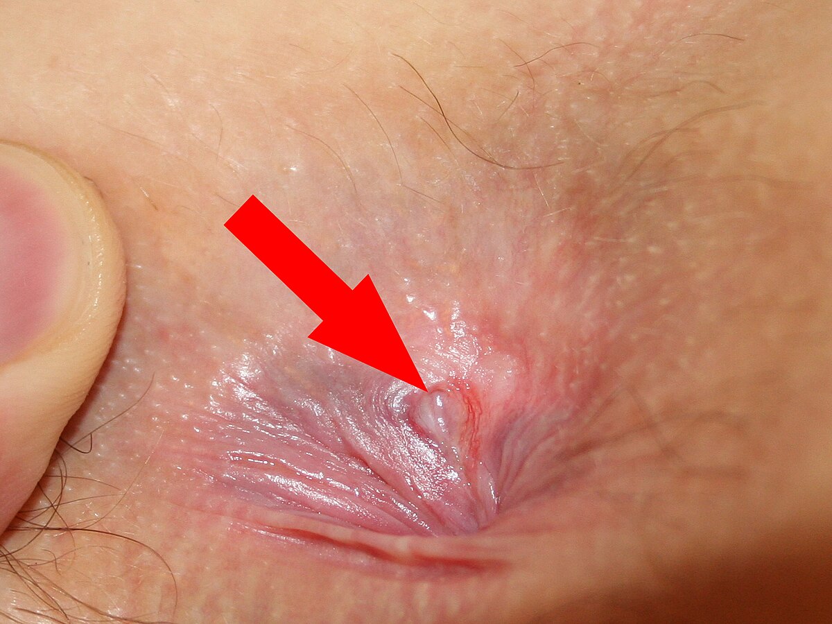 :Anal fissure 1.jpg