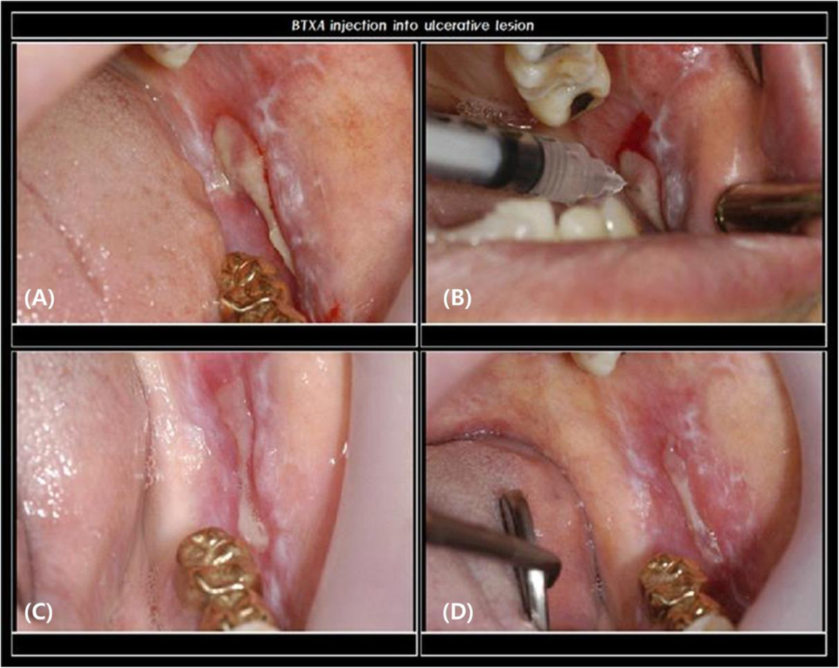 Application of botulinum toxin in maxillofacial field: Part II. Wrinkle intraoral ulcer and cranio-maxillofacial pain