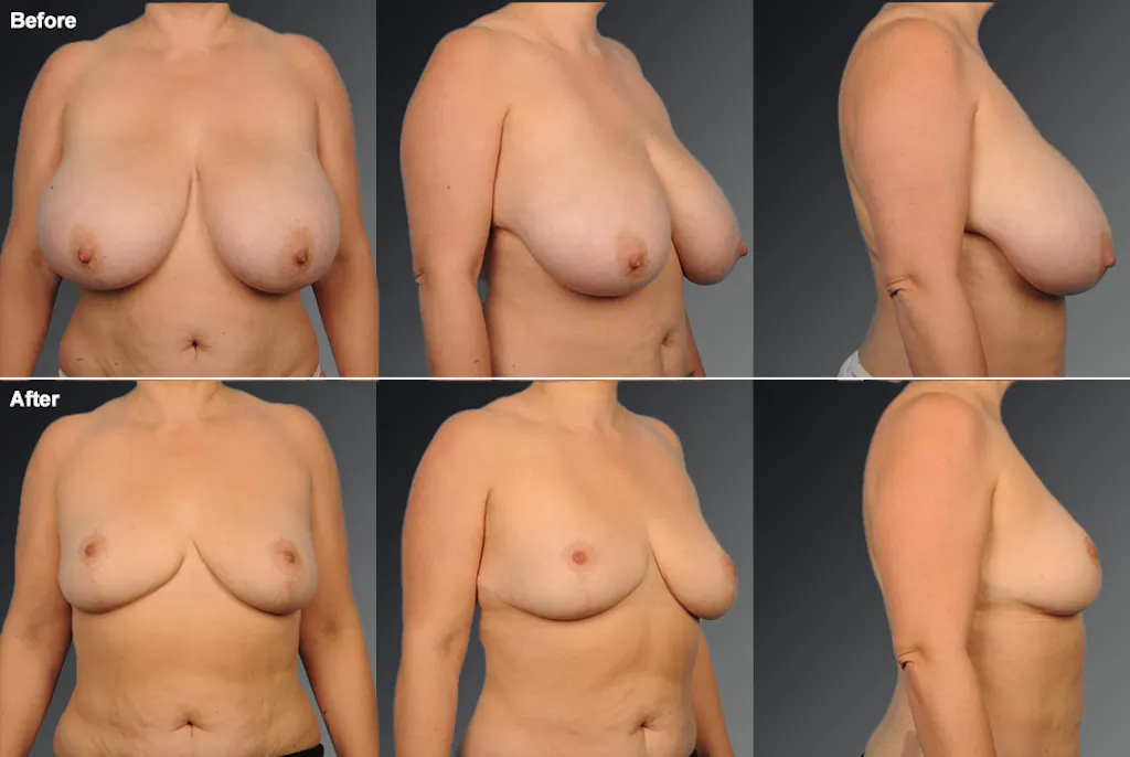 Breast Reduction Los Angeles