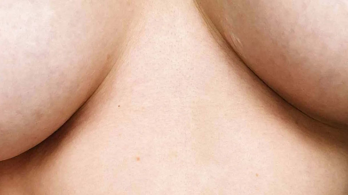 I Got a Breast Lift and Internal Bra in My Quest for Perky Boobs