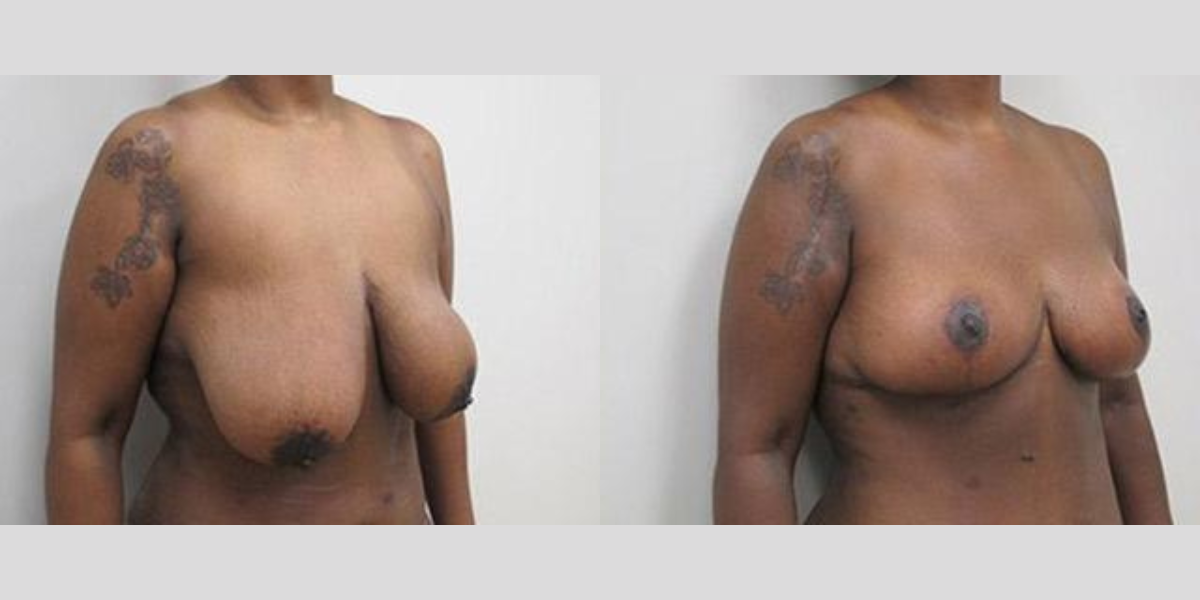 Large Breast Reduction Surgery for Black Woman in Her Late 40s Before After Photos New Jersey