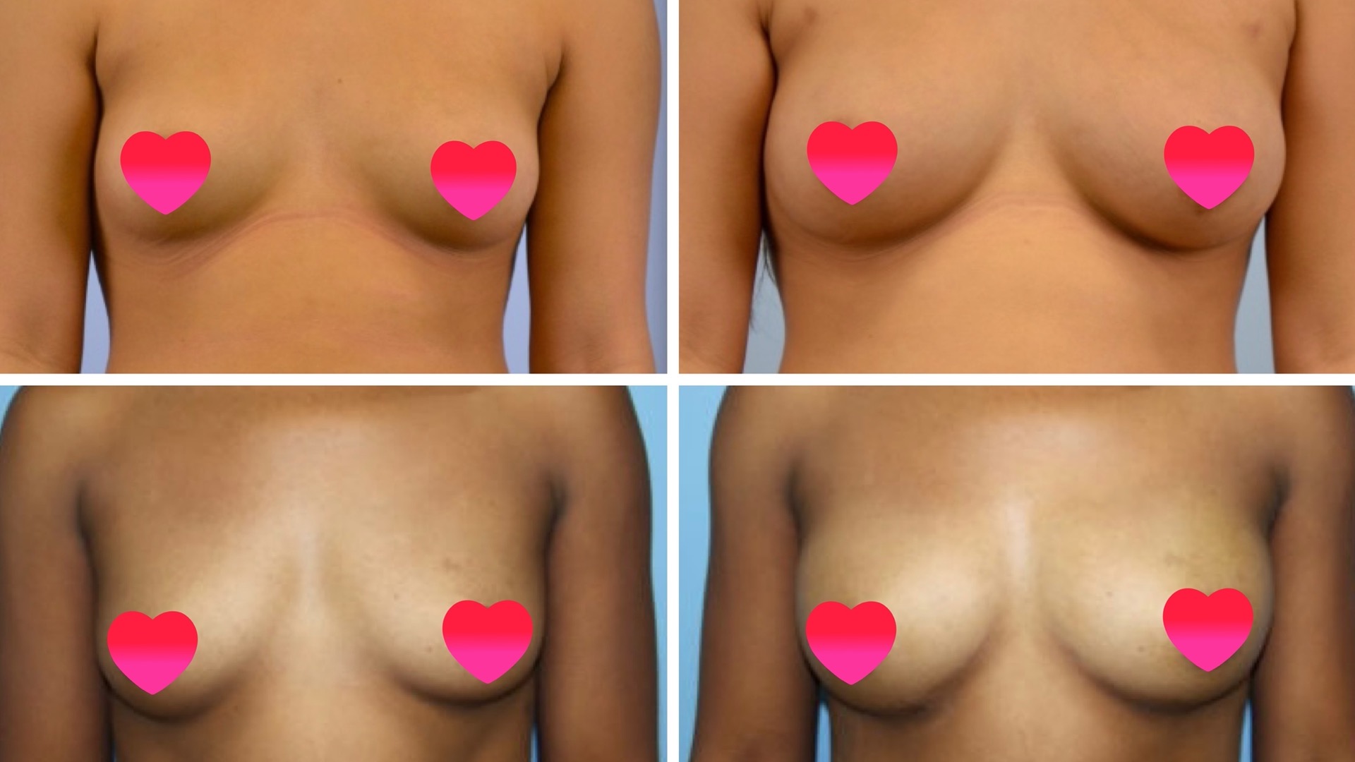 Natural breast augmentation by Beverly Hills Female Plastic Surgeon Dr. Cat Begovic
