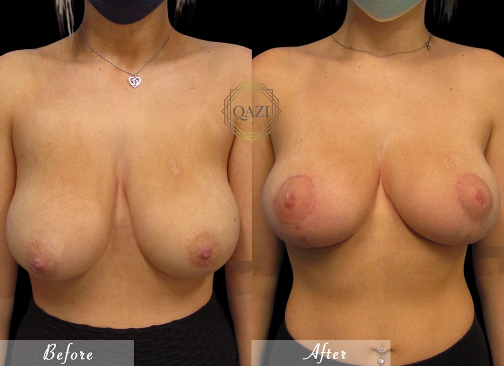 Natural Breast Augmentation