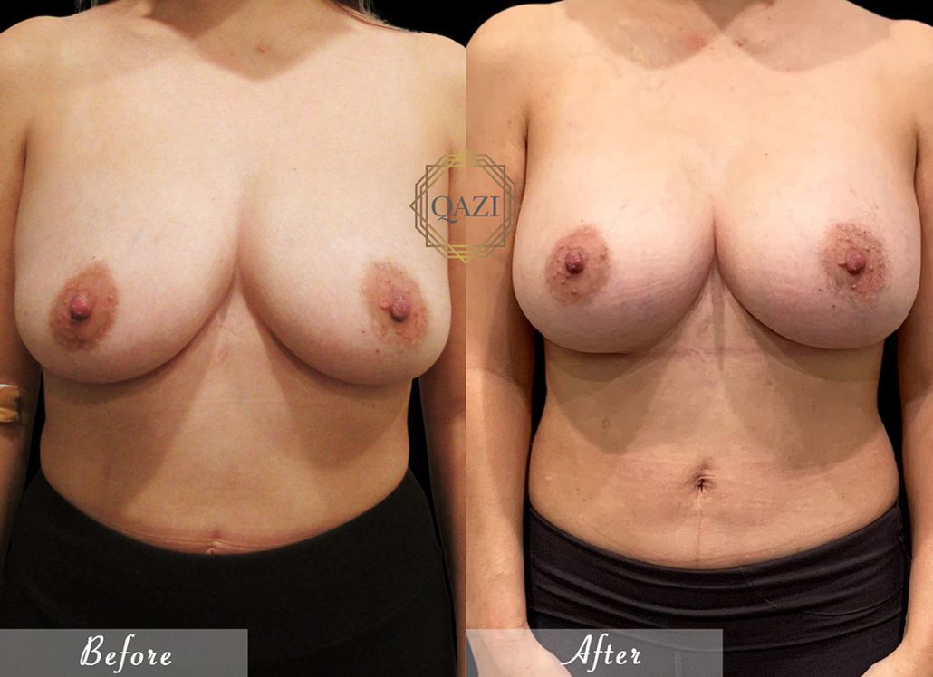 Natural Breast Augmentation