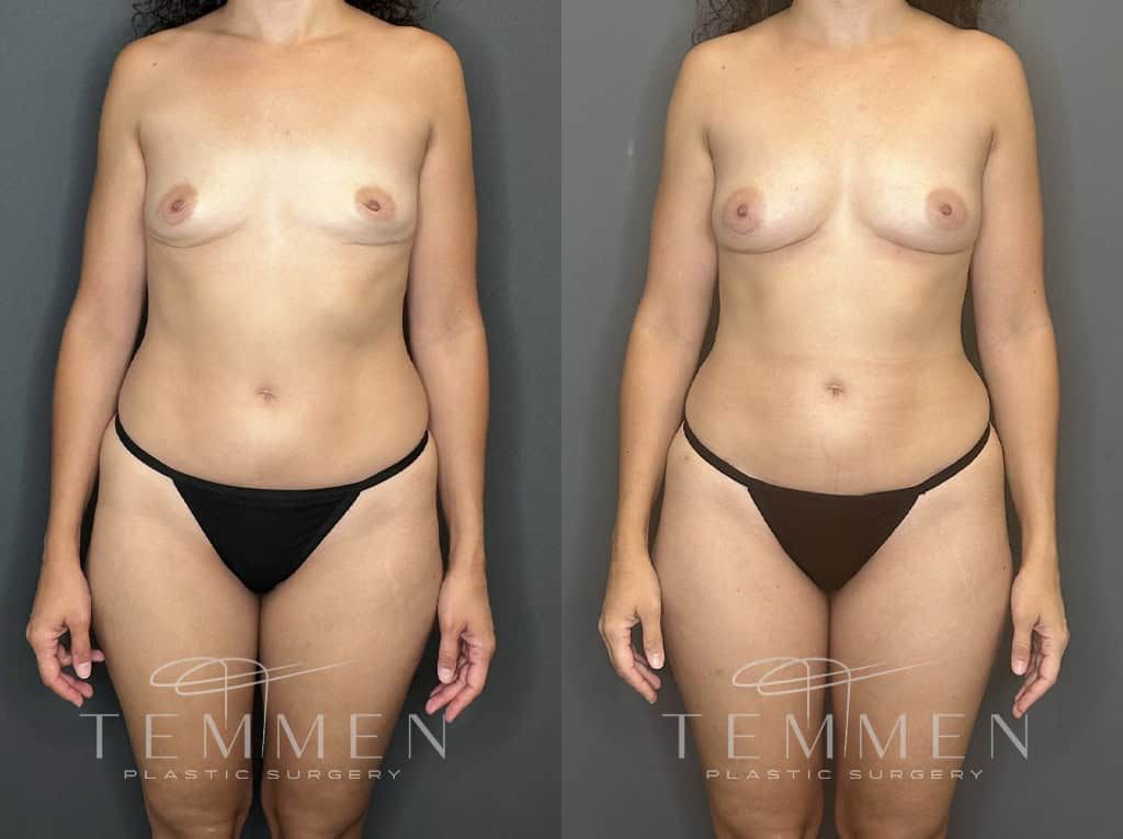 Natural Breast Augmentation Tampa FL