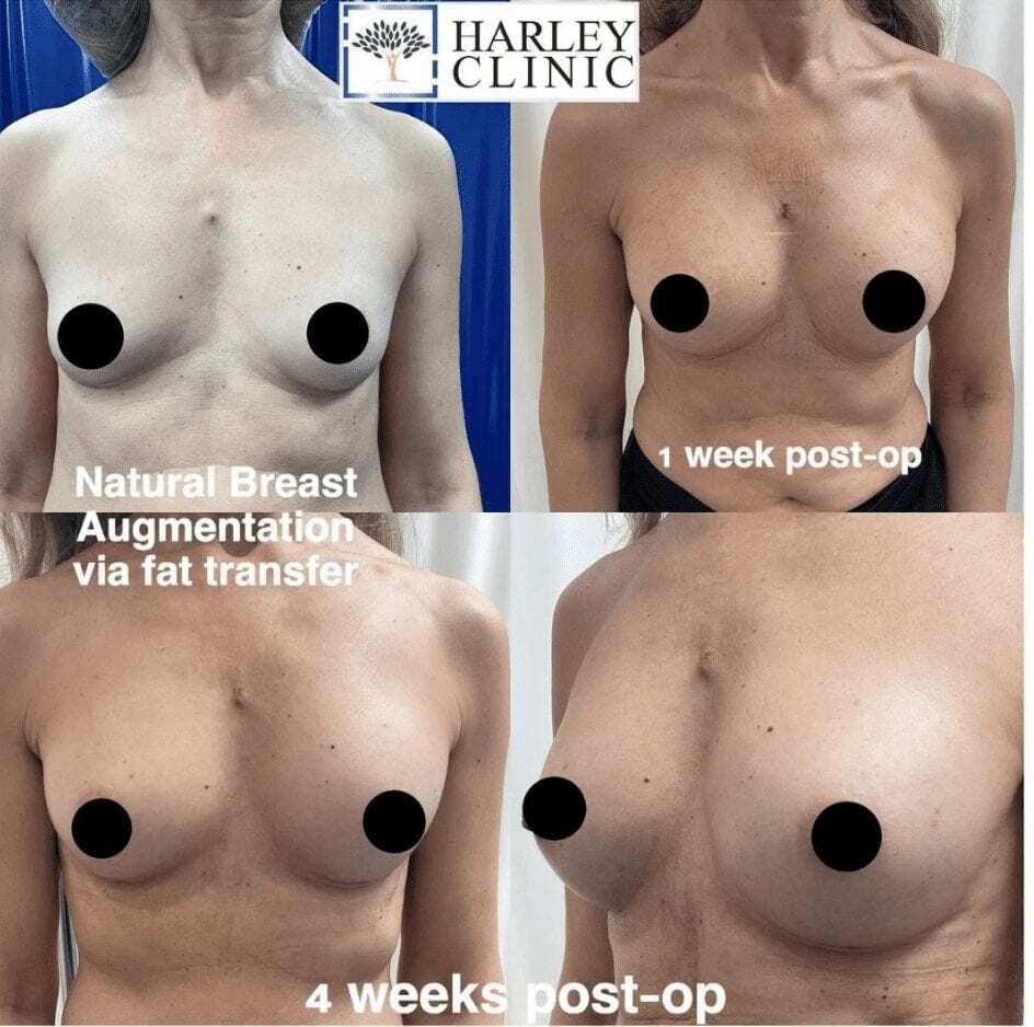 Breast Augmentation: Implants vs Fat Transfer