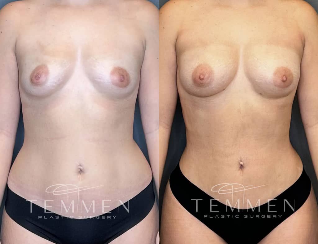 Natural Breast Augmentation Tampa FL
