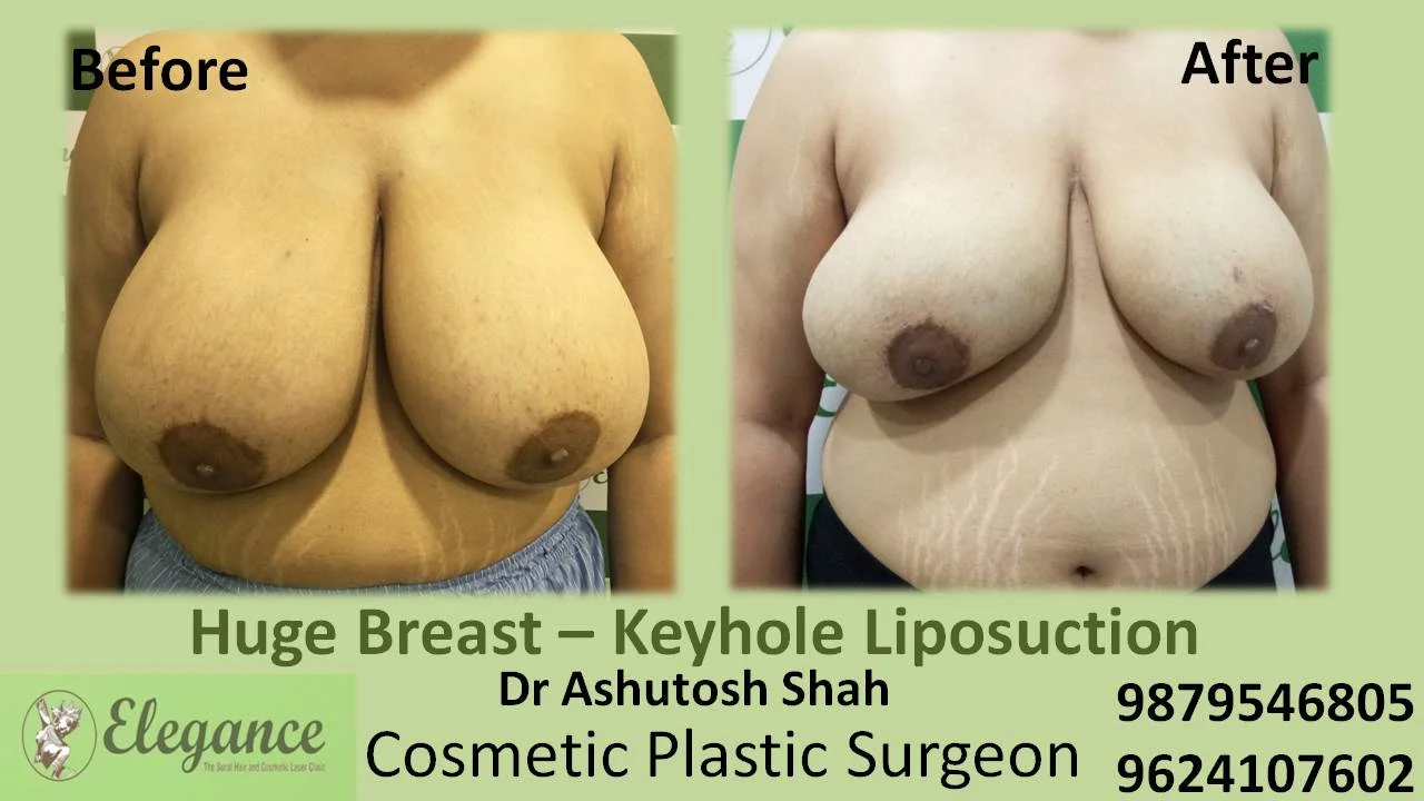 Breast Reduction In Madurai Tamil Nadu India