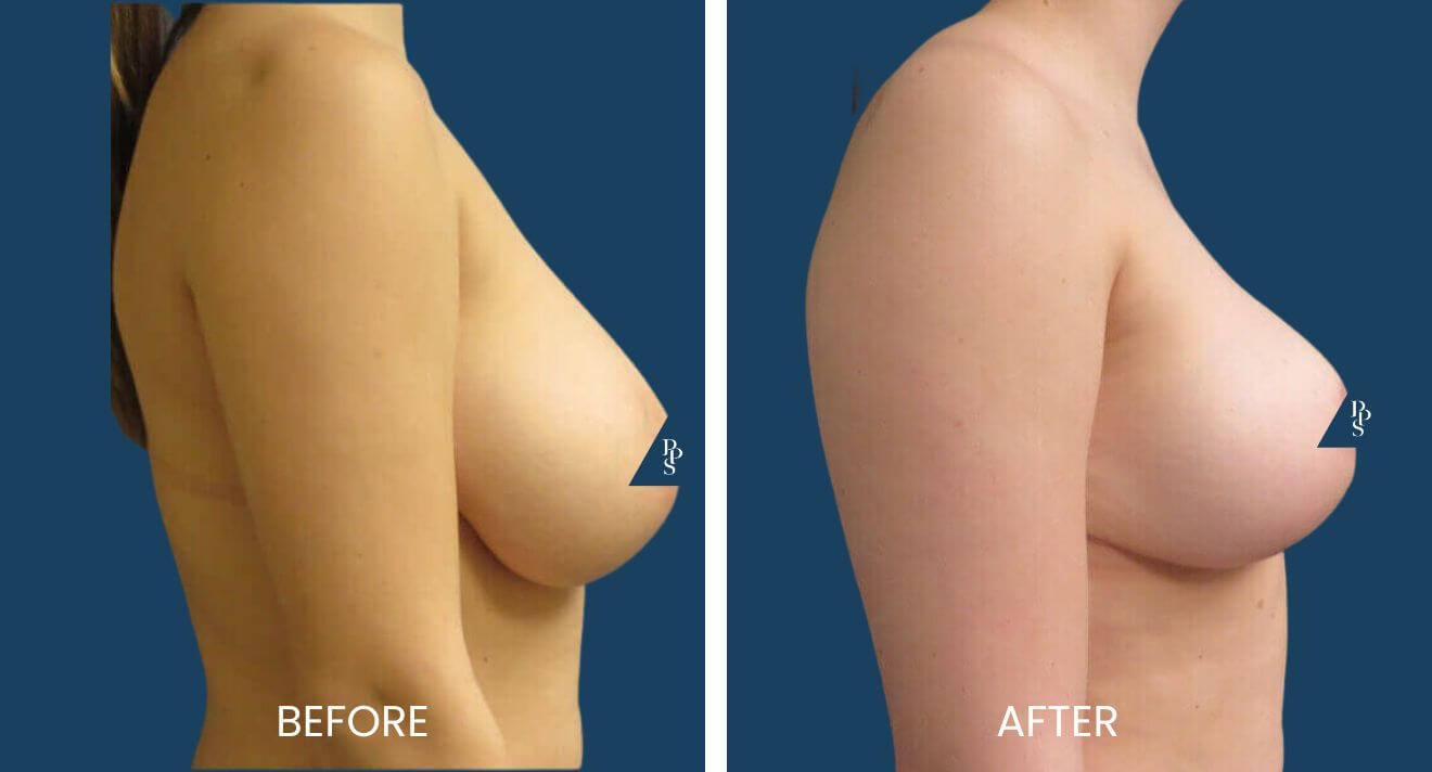 Breast augmentation with Breast Lift