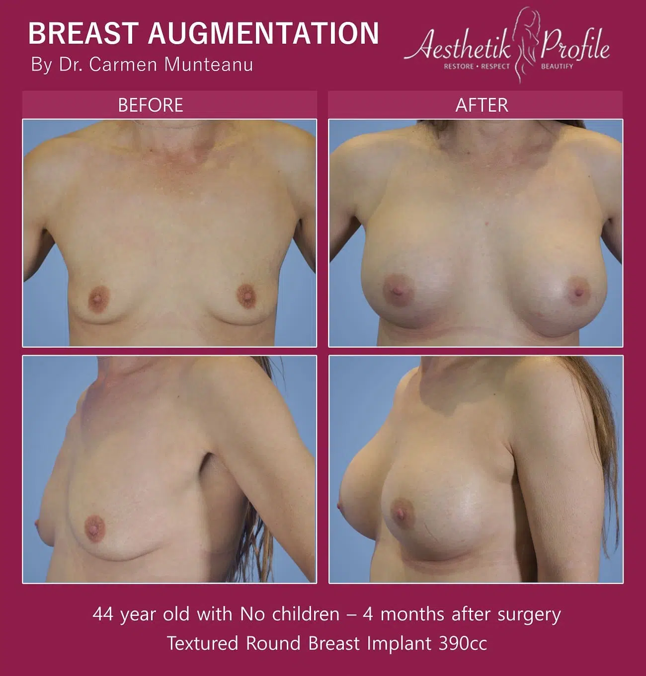 Round or Anatomical Breast Implants