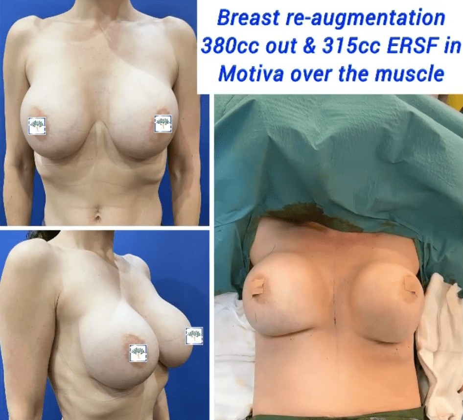 Breast Implants Under the Muscle vs Over