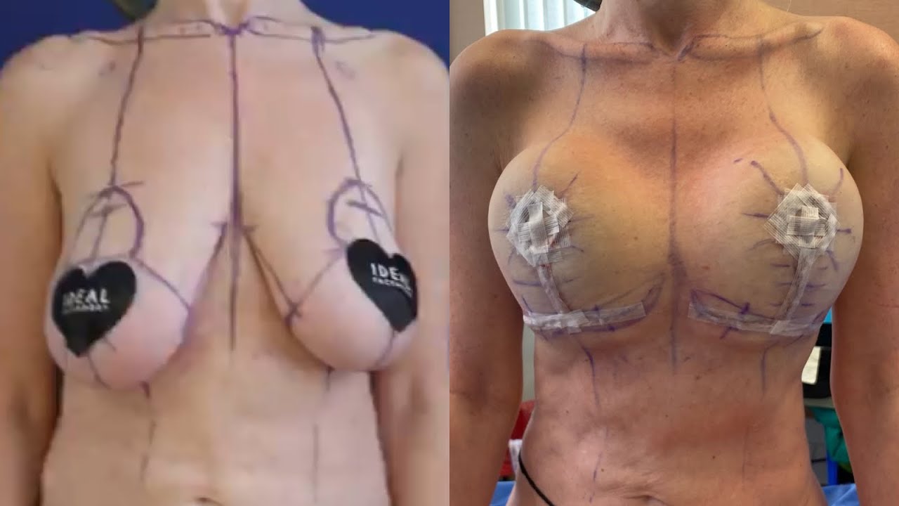 Awake Breast Lift Beverly Hills