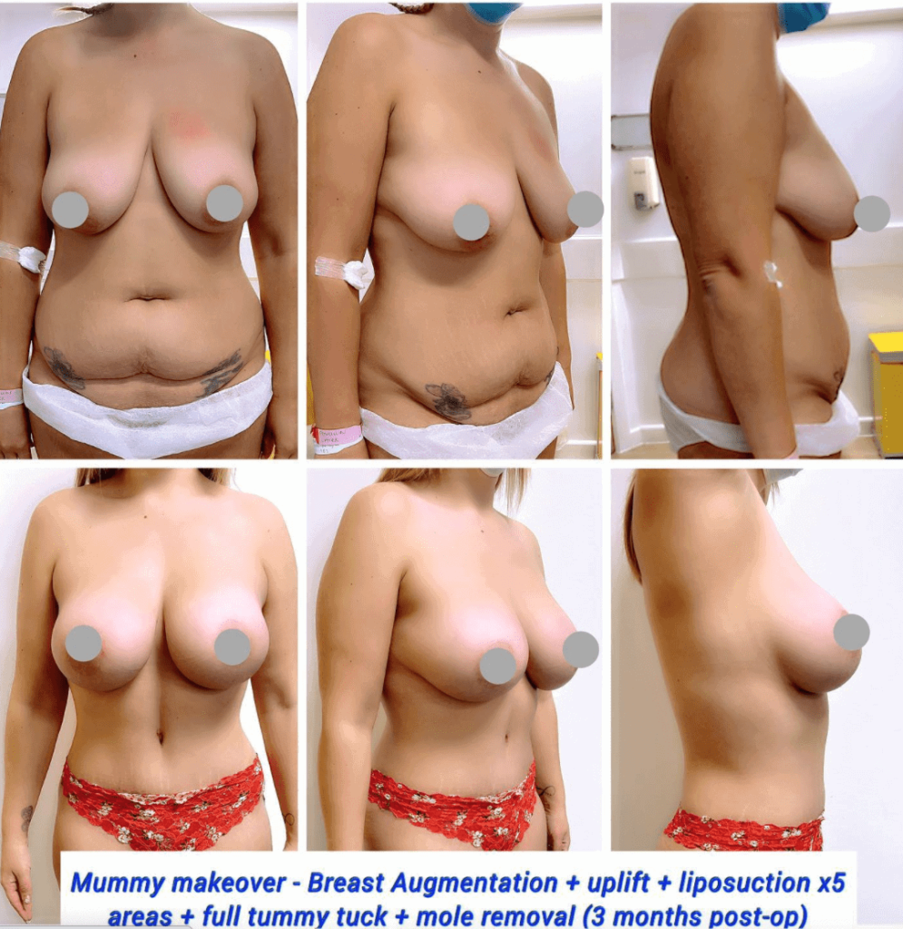 Breast Augmentation Mastopexy