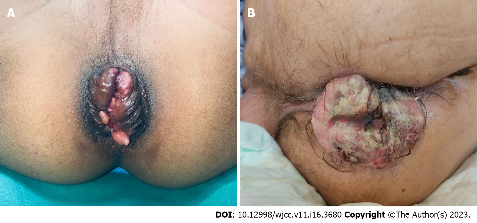 Current diagnostic tools and treatment modalities for rectal prolapse