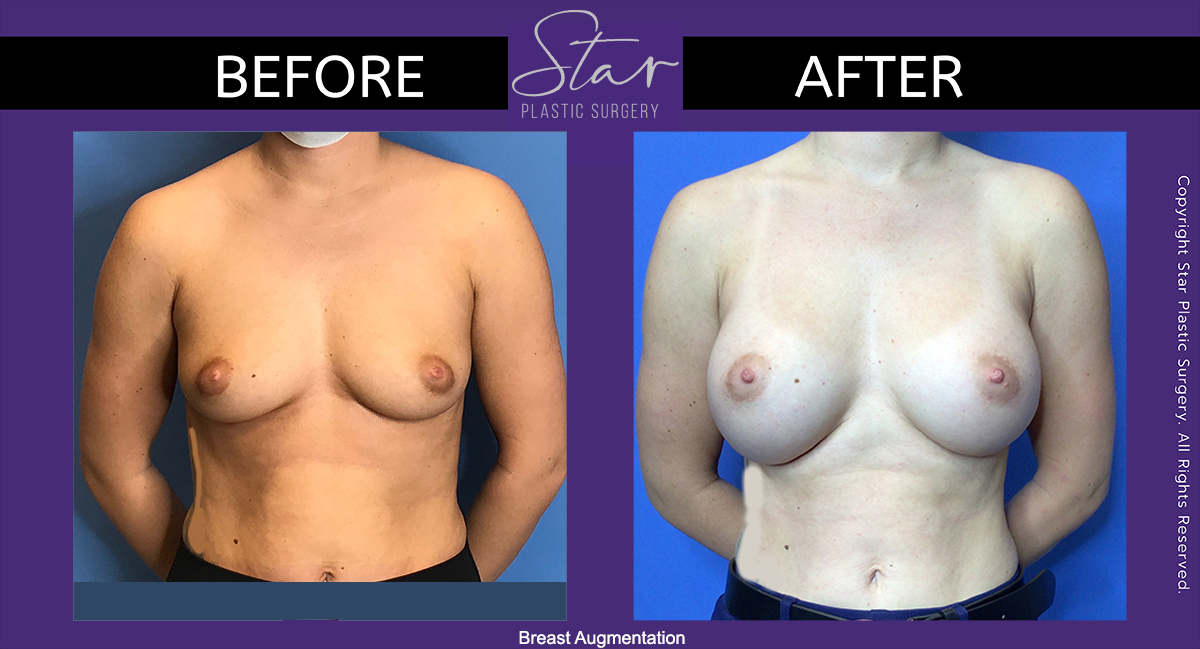 Breast Augmentation Archives