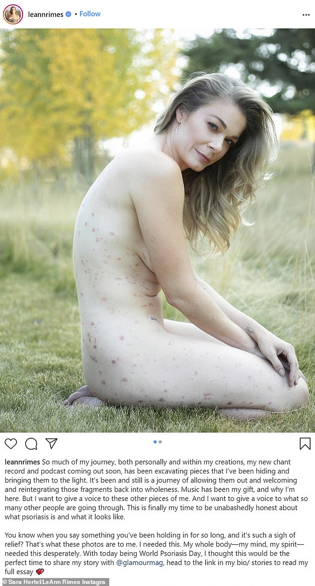 LeAnn Rimes poses NUDE on social media: My time to be unabashedly honest about what psoriasis is