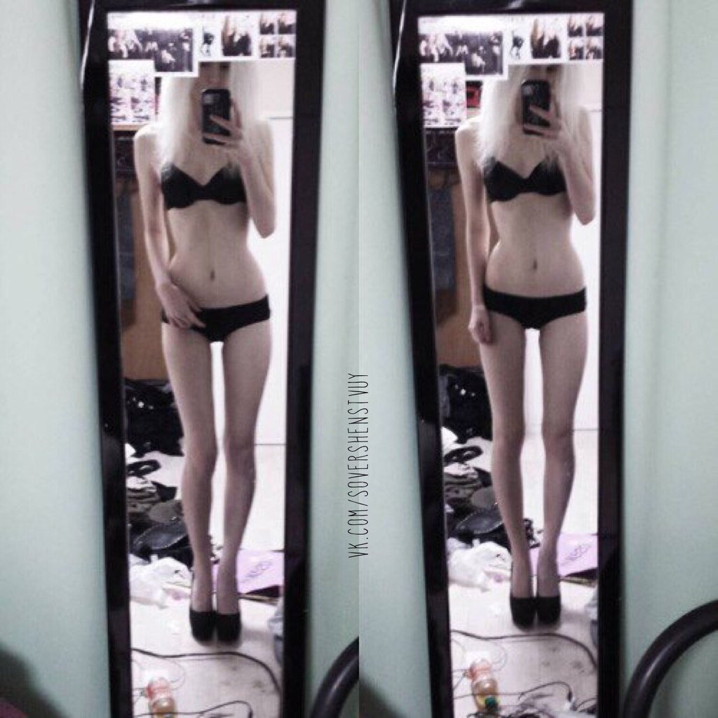 Anorexic woman
