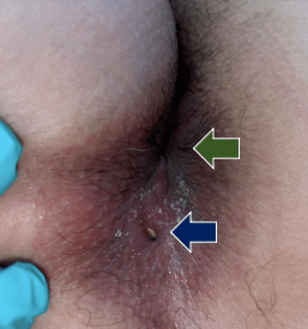 Anal Canal Duplication in a 25-Year-Old Female Patient