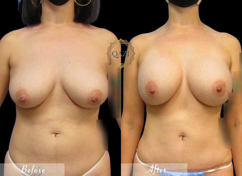 Natural Breast Augmentation