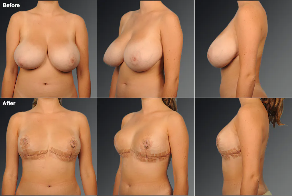 Breast Reduction Los Angeles