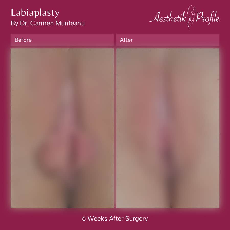 Labiaplasty