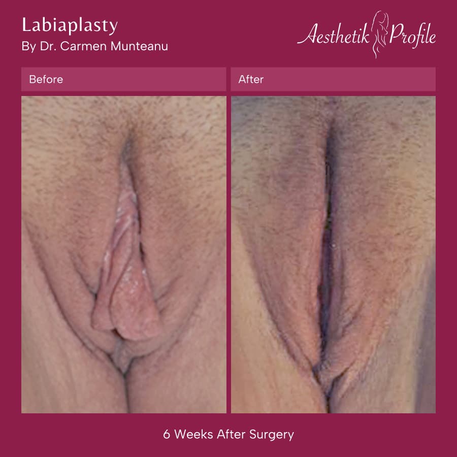 Labiaplasty
