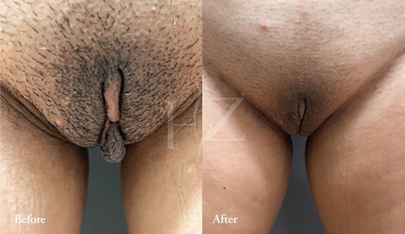 What Is Labiaplasty And What Does It Involve? Vado Plastic Surgery