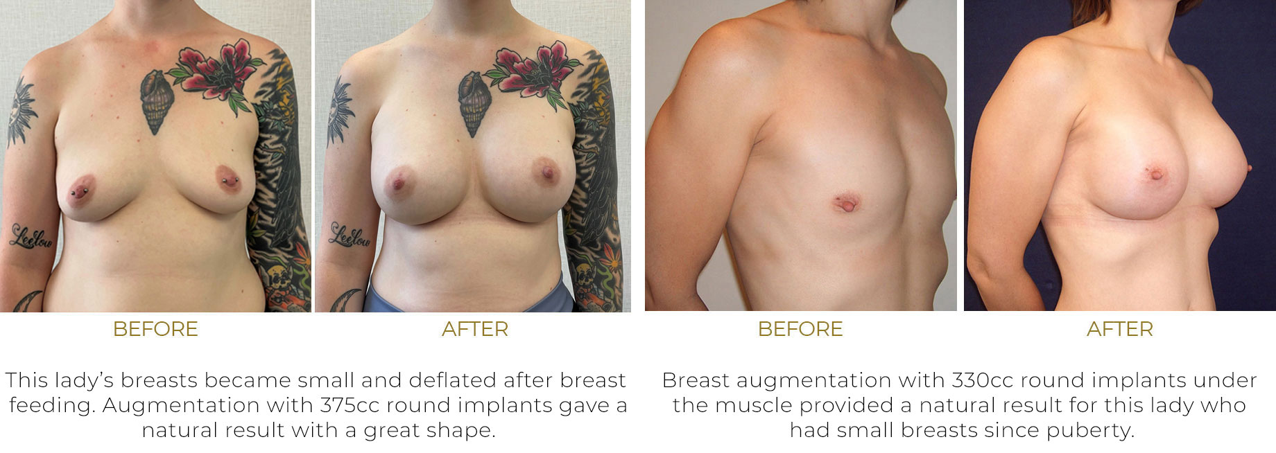 Breast Augmentation London