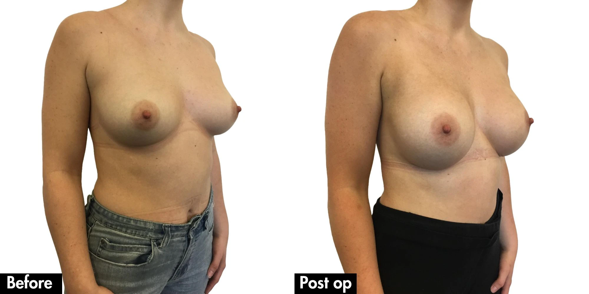 Teardrop vs Round Implants
