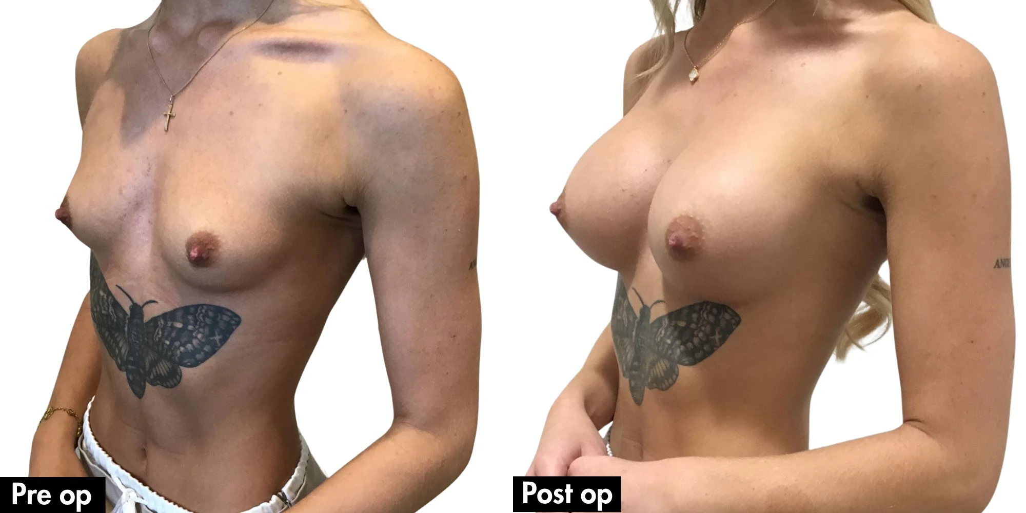 Teardrop vs Round Implants