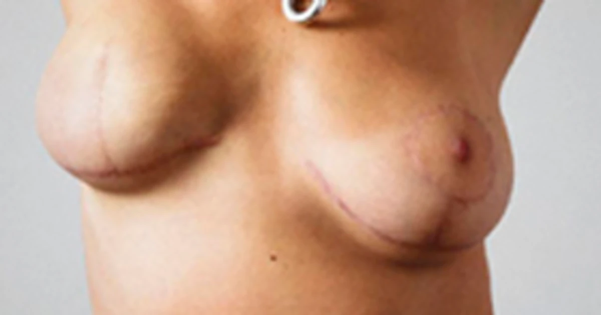 Pose nude? No way. After breast cancer? OK!