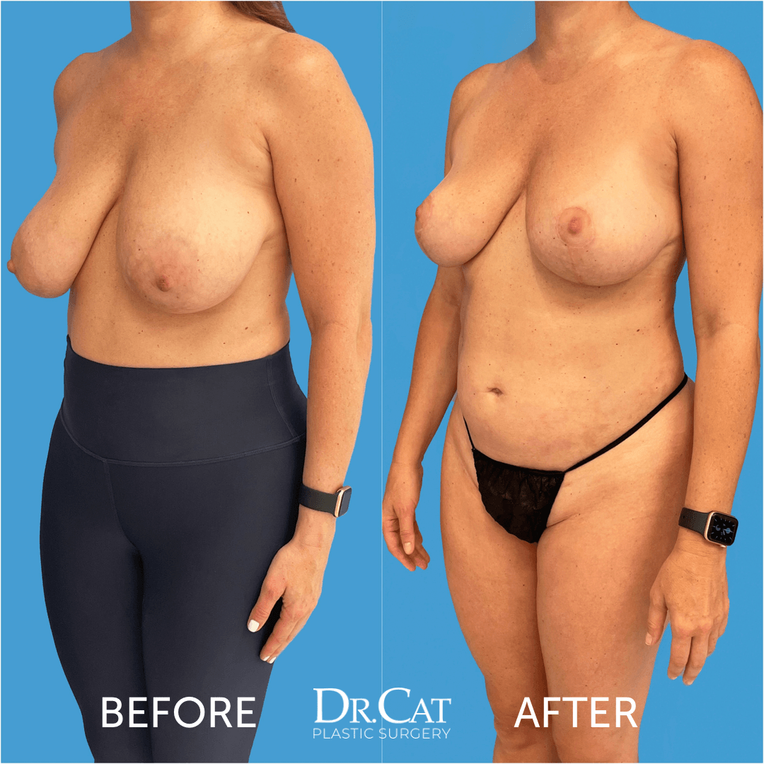 Sagging Breasts: Causes Treatment Options and Solutions