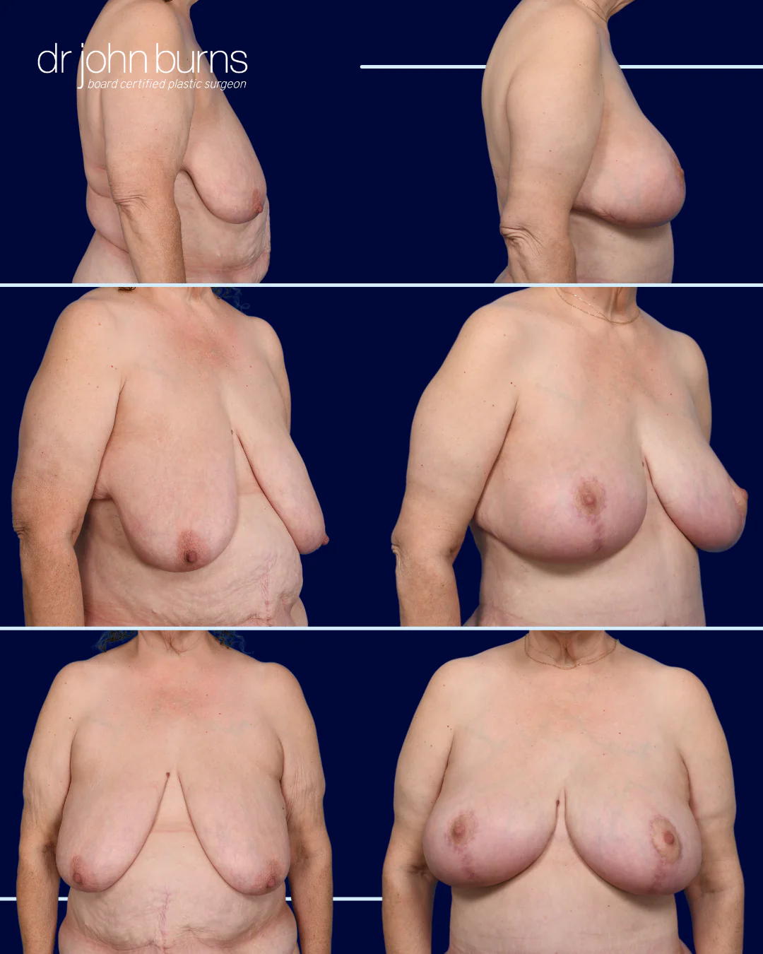 Bouncing Back From Ozempic Breasts- Dr. John Burns- Dallas Plastic Surgeon
