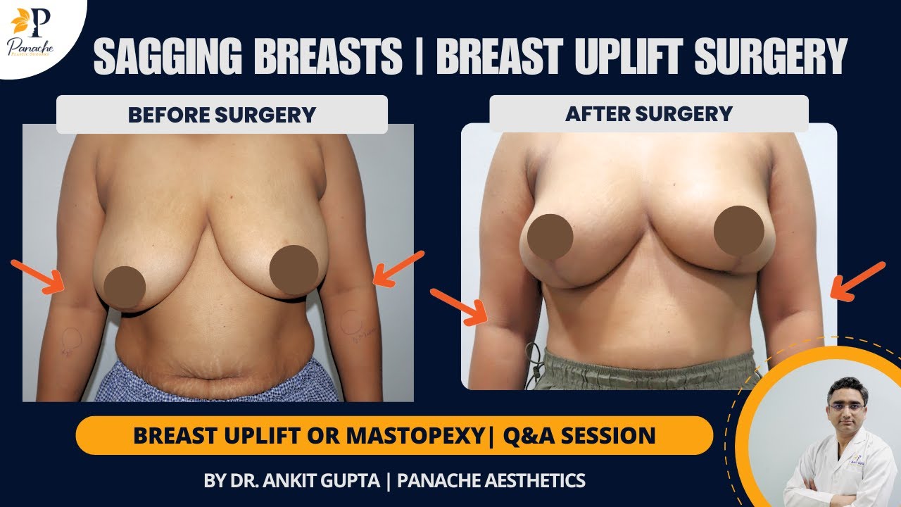 Breast Lift