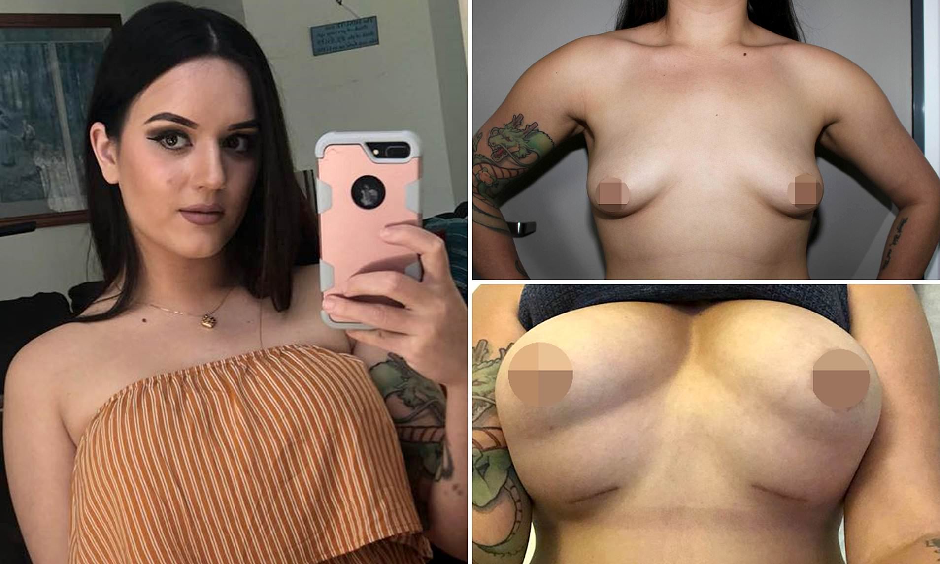 Woman left with bubble boobs after the plastic surgery she spent her life savings on went wrong